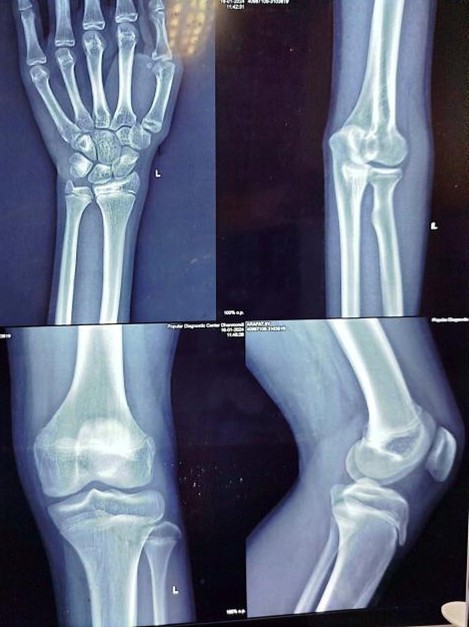 Advanced bone age (16-17 years)